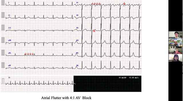 8ecf_atrialflutter.jpg