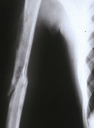 Osteomyelitis