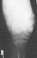 Osteosarcoma