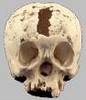 Source: http://www.nmhm.washingtondc.museum/explore/anatifacts/imgz/a5syphilis_skull.gif